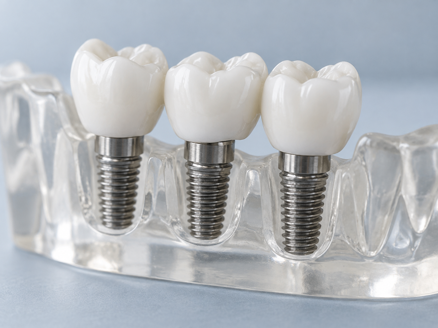 Implantes dentários em titânio com coroas de cerâmica